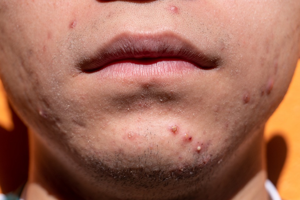 close up of boy chin with acne