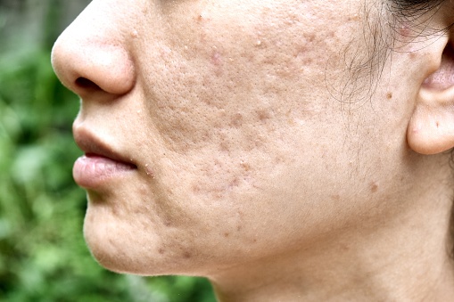 Skin problem with acne diseases