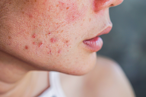 closeup acne on woman's face