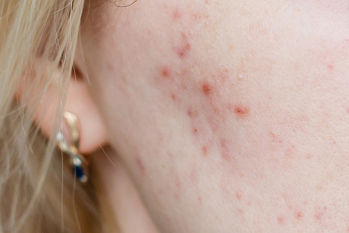 Close up photo of nodular cystic acne skin