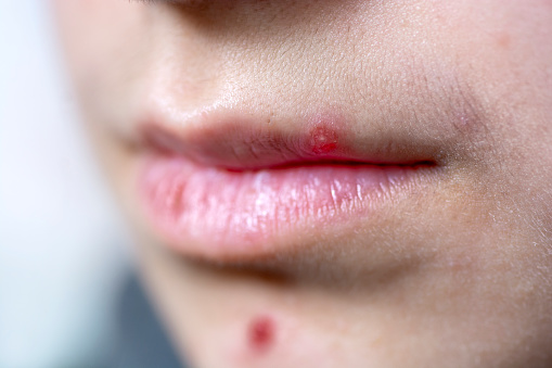 How to Get Rid of Lip Acne?