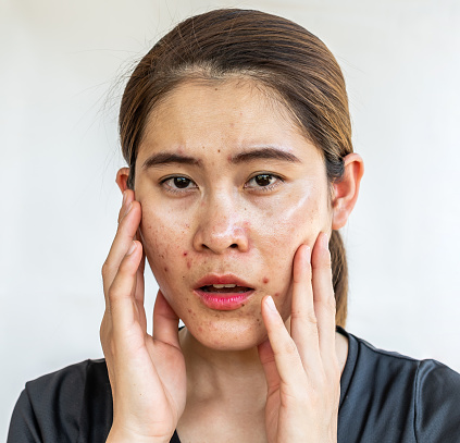 Oily skin is the result of the overproduction of sebum from sebaceous glands.