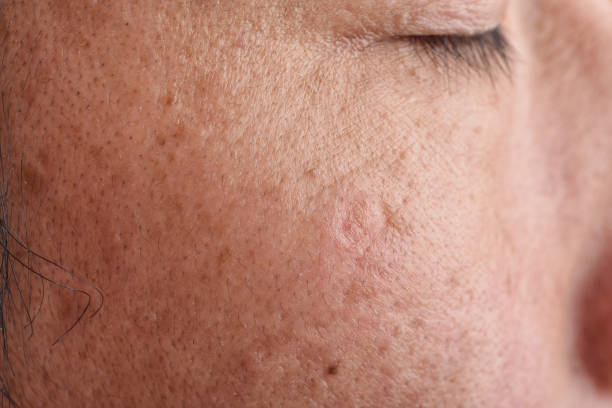 Skin problem with wrinkle and pigmentation